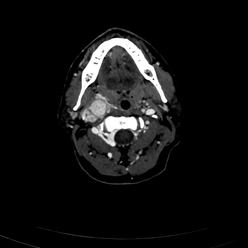 Carotid body tumor (Radiopaedia 83615-98727 D 45).jpg