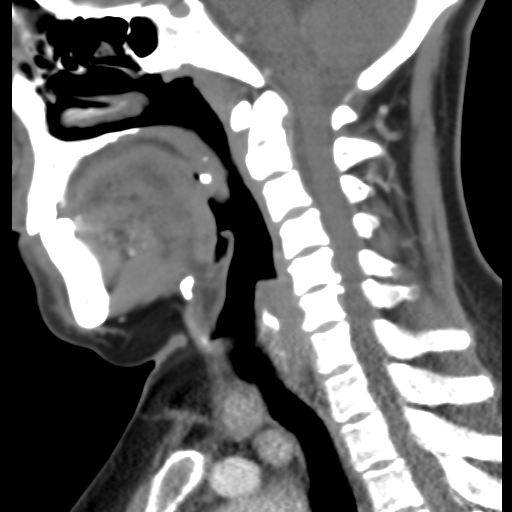 File:Carotid body tumor (paraganglioma) (Radiopaedia 38586-40729 C 16).jpg