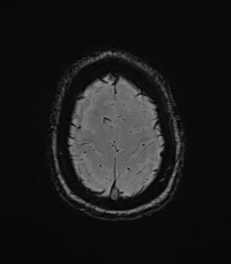 File:Cavernoma with bleed - midbrain (Radiopaedia 54546-60773 Axial SWI 42).png