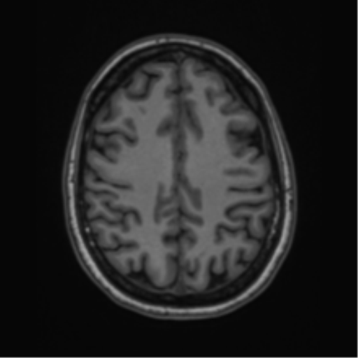 Cavernoma with bleed - midbrain (Radiopaedia 54546-60774 Axial T1 39).png