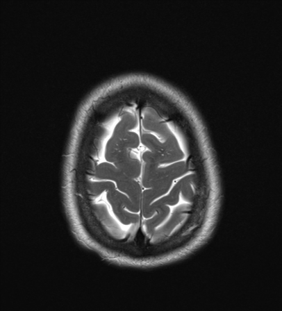File:Cavernoma with bleed - midbrain (Radiopaedia 54546-60774 Axial T2 25).png