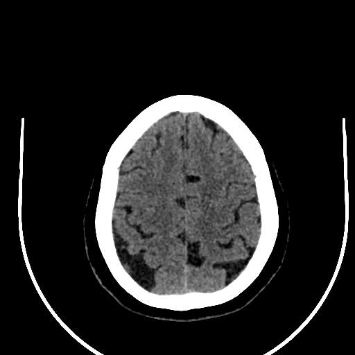 Cavernous hemangioma of the cerebellar falx (Radiopaedia 73025-83723 Axial non-contrast 109).jpg