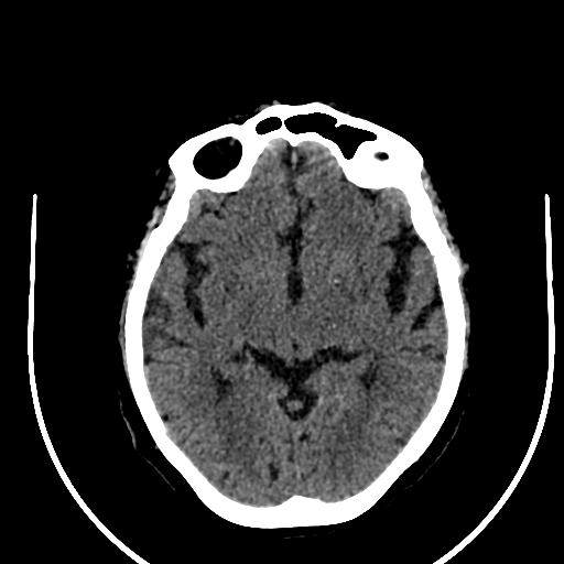 Cavernous hemangioma of the cerebellar falx (Radiopaedia 73025-83723 Axial non-contrast 62).jpg