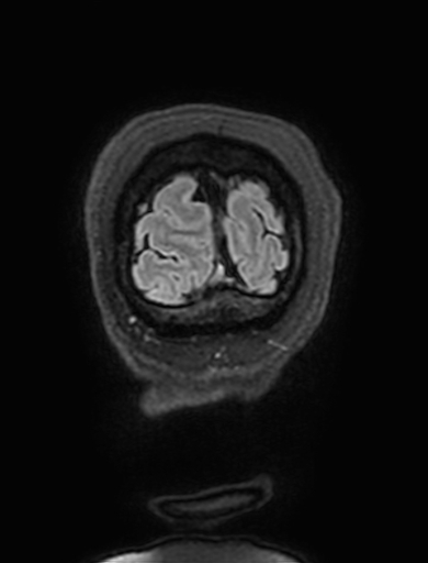 Cavernous hemangioma of the cerebellar falx (Radiopaedia 73025-83724 Coronal FLAIR 342).jpg