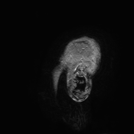 File:Cavernous hemangioma of the cerebellar falx (Radiopaedia 73025-83724 Sagittal T1 C+ 214).jpg
