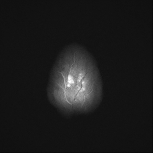 File:Cavernous malformation (cavernous angioma or cavernoma) (Radiopaedia 36675-38237 Axial T2 23).png