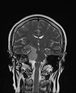 File:Cavernous sinus meningioma (Radiopaedia 63682-72367 Coronal T2 10).jpg
