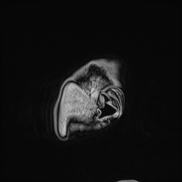 Cavernous sinus meningioma (Radiopaedia 63682-72367 Sagittal T1 C+ 14).jpg
