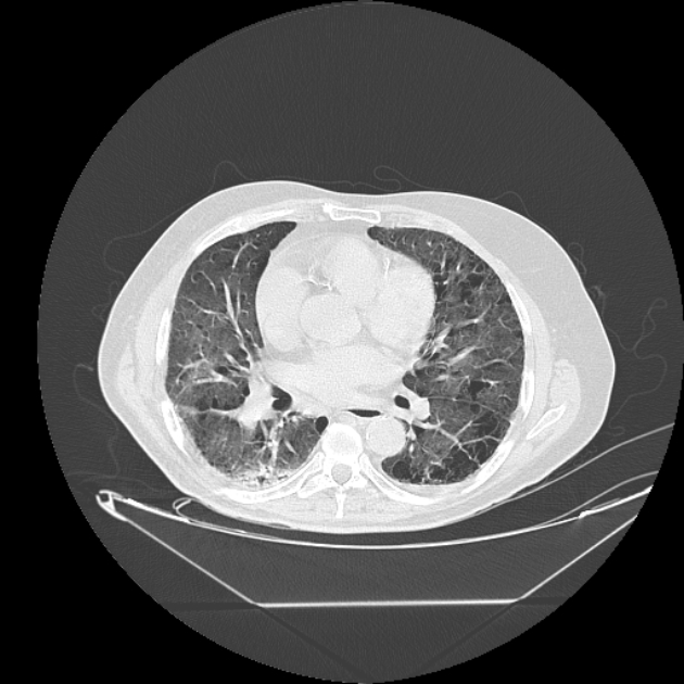 Cavitating bronchogenic carcinoma (Radiopaedia 44489-48162 Axial lung window 47).jpg