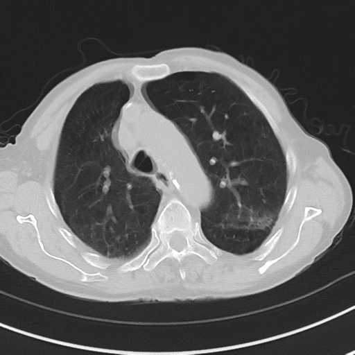 Cavitating pneumonia - lingular segments (Radiopaedia 34386-35678 Axial lung window 20).png
