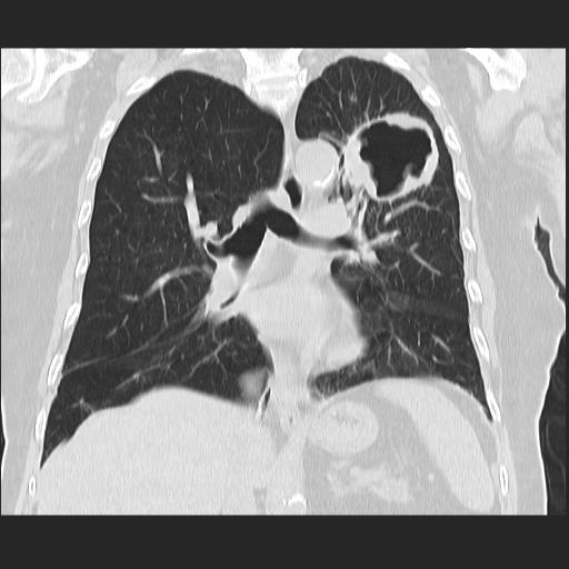 File:Cavitating pulmonary metastases (Radiopaedia 89545-106544 Coronal lung window 24).jpg