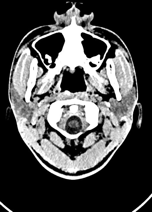 Cavum septum pellucidum and cavum vergae (Radiopaedia 77797-90060 Axial Brain Window 3).jpg