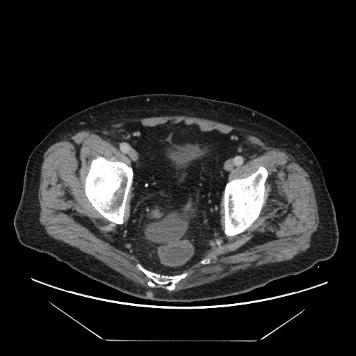 Cecal adenocarcinoma (Radiopaedia 64871-73817 A 86).jpg