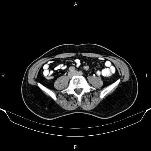 Cecal adenocarcinoma (Radiopaedia 85324-100916 Axial C+ delayed 63).jpg