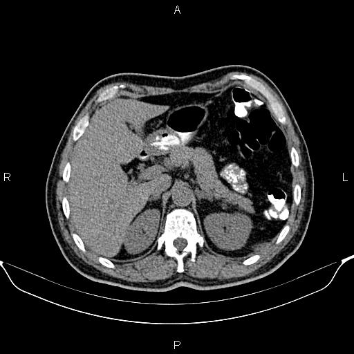 Cecal adenocarcinoma (Radiopaedia 85324-100916 Axial non-contrast 24).jpg
