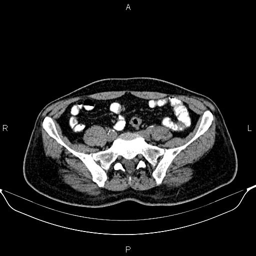 Cecal adenocarcinoma (Radiopaedia 85324-100916 Axial non-contrast 70).jpg
