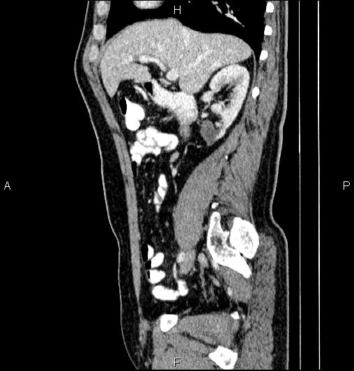 Cecal adenocarcinoma (Radiopaedia 85324-100916 E 32).jpg