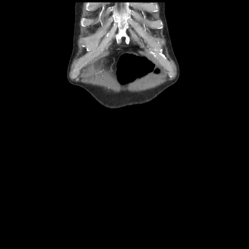 Cecal volvulus (Radiopaedia 89212-106088 D 3).jpg