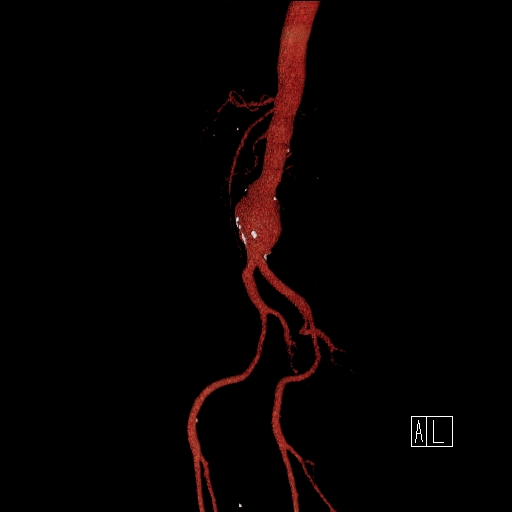 File:Celiac artery compression by the diaphragmatic crurae (Radiopaedia 31739-32666 3D CTA 16).jpg