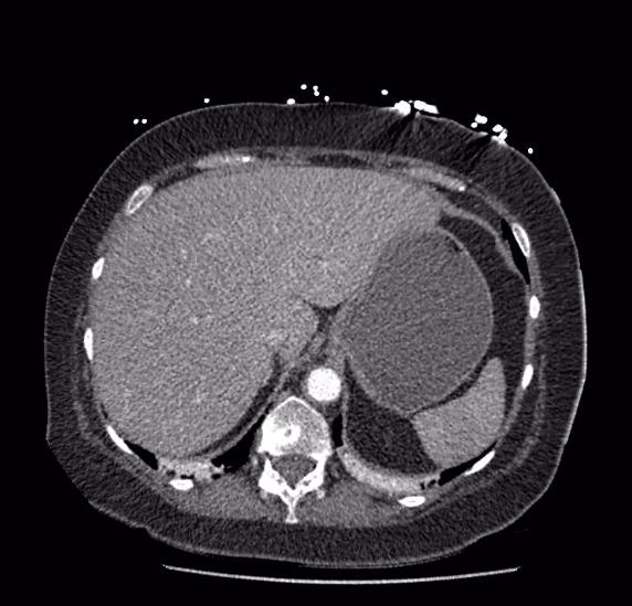 File:Celiac artery severe stenosis and dissection (Radiopaedia 44128-47842 B 12).jpg