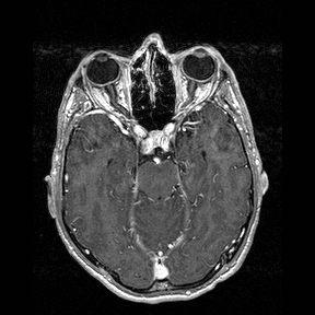 Central-variant posterior reversible encephalopathy syndrome (PRES) (Radiopaedia 43880-47358 Axial T1 C+ 54).jpg