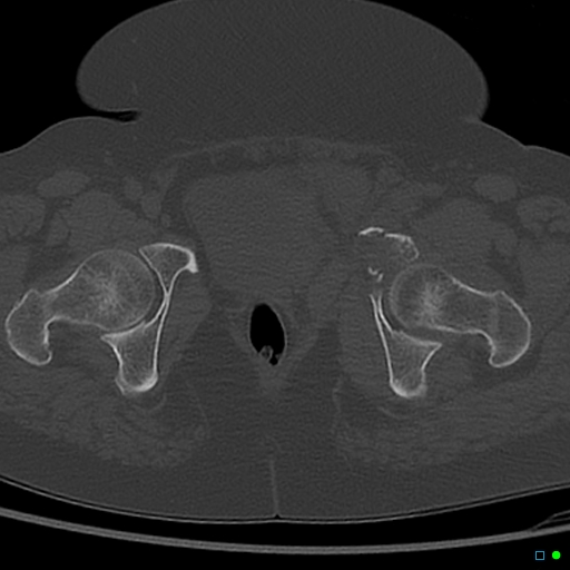 Central fracture-dislocation of the acetabulum (Radiopaedia 36578-38150 Axial bone window 68).jpg