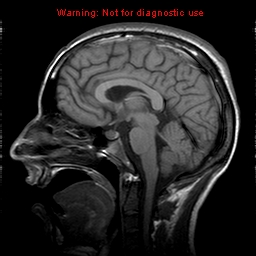 File:Central nervous system vasculitis (Radiopaedia 8410-9235 Sagittal T1 12).jpg
