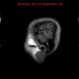 File:Central nervous system vasculitis (Radiopaedia 8410-9235 Sagittal T1 22).jpg