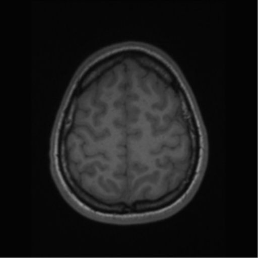 File:Central neurocytoma (Radiopaedia 37664-39557 Axial T1 61).png