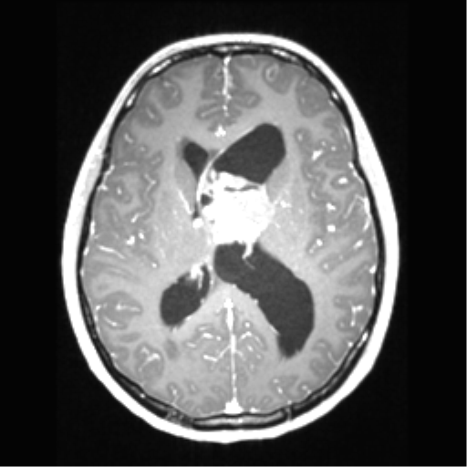 Central neurocytoma (Radiopaedia 37664-39557 Axial T1 C+ 45).png
