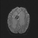 Central neurocytoma (Radiopaedia 56690-63469 Axial DWI 33).jpg