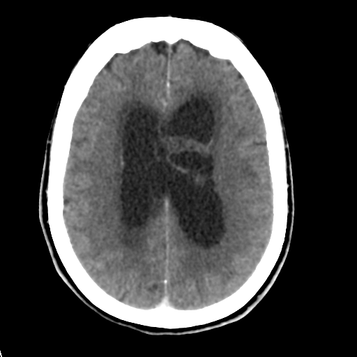Central neurocytoma (Radiopaedia 65317-74346 Axial C+ delayed 32).png