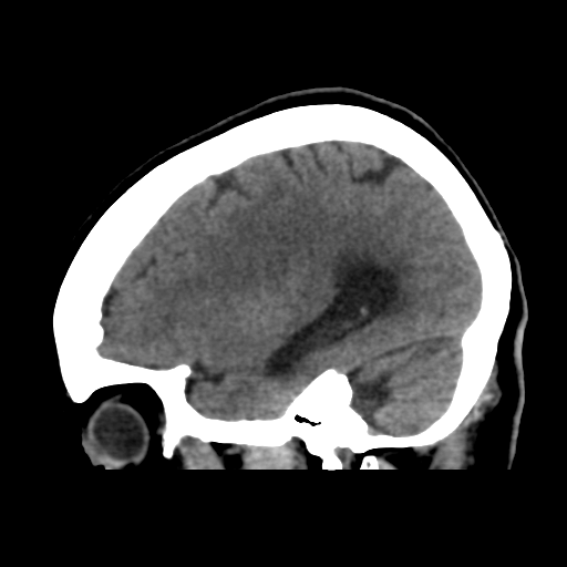 File:Central neurocytoma (Radiopaedia 65317-74346 C 16).png