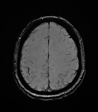 Central neurocytoma (Radiopaedia 71068-81303 Axial SWI 49).jpg