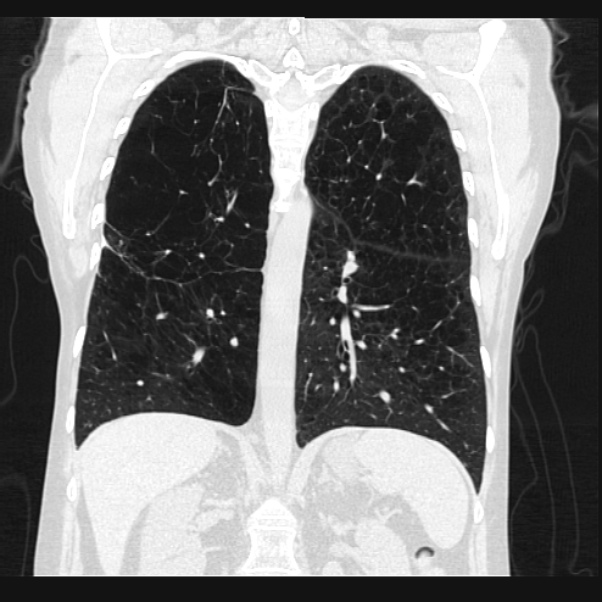 Centrilobular pulmonary emphysema (Radiopaedia 24495-24789 Coronal lung window 49).jpg