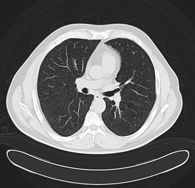 Centrilobular pulmonary emphysema (Radiopaedia 26808-26971 C 22).jpg