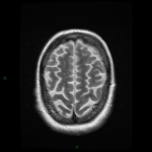 File:Cerebellar abscess (Radiopaedia 78135-90678 Axial T2 25).jpg