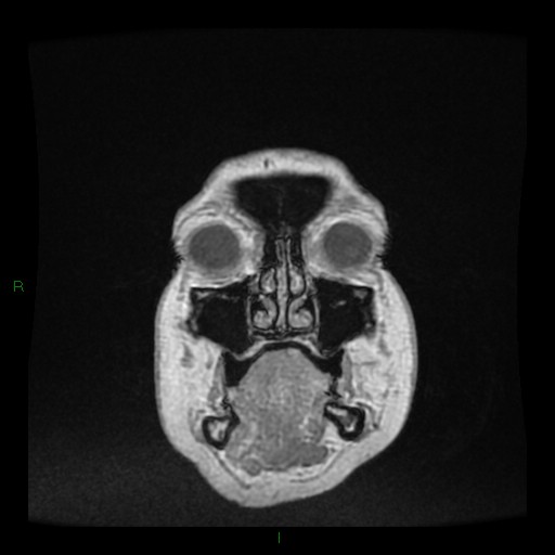 File:Cerebellar abscess (Radiopaedia 78135-90678 Coronal T1 C+ 5).jpg