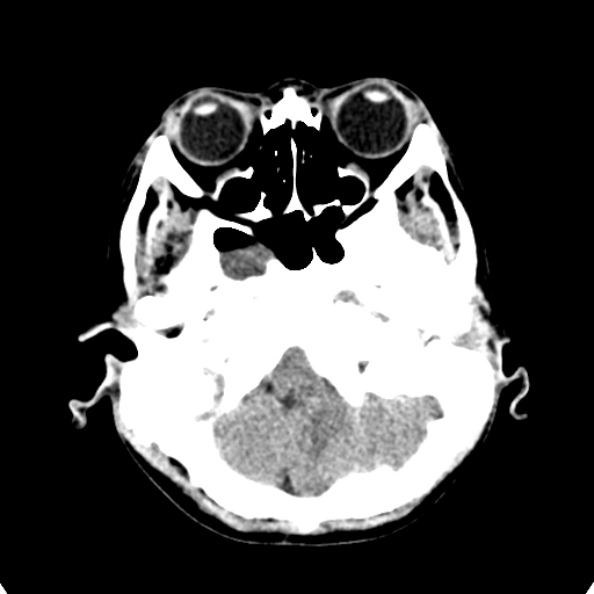Cerebellar abscess secondary to mastoiditis (Radiopaedia 26284-26412 Axial non-contrast 24).jpg