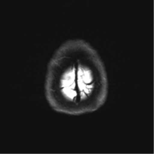 Cerebellar agenesis with hypoplastic pons (pontocerebellar hypoplasia) (Radiopaedia 57224-64138 Axial DWI 36).png