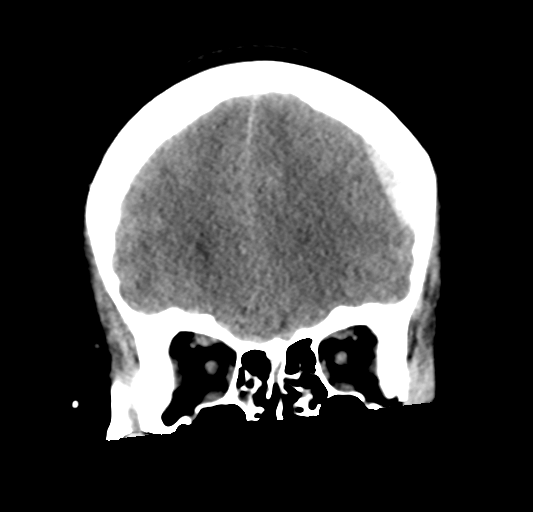 File:Cerebellar ependymoma complicated by post-operative subdural hematoma (Radiopaedia 83322-97737 Coronal non-contrast 10).png