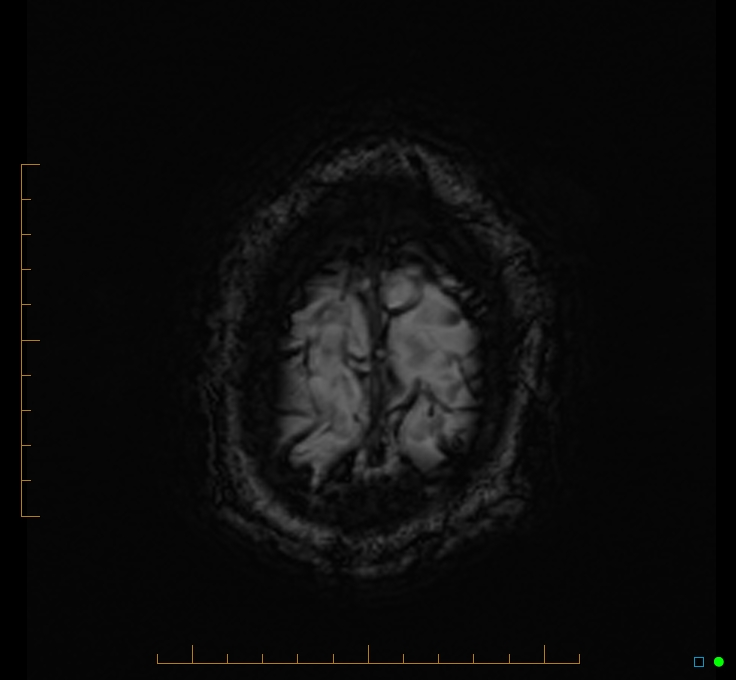Cerebellar gangliocytoma (Radiopaedia 65377-74422 Axial SWI 57).jpg