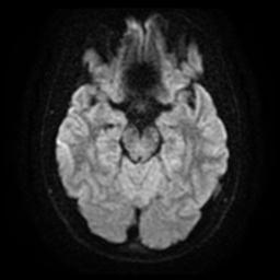 Cerebellar hemangioblastoma (Radiopaedia 29570-30077 Axial DWI 11).jpg