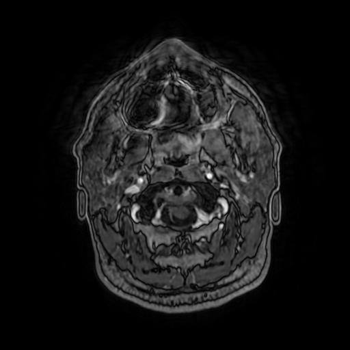 File:Cerebellar hemangioblastoma (Radiopaedia 88055-104622 Axial T1 C+ 20).jpg