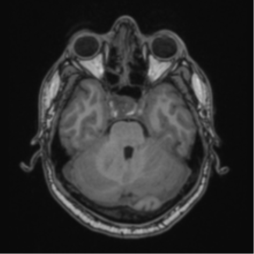 Cerebellar hemangioblastomas and pituitary adenoma (Radiopaedia 85490-101176 Axial T1 23).png