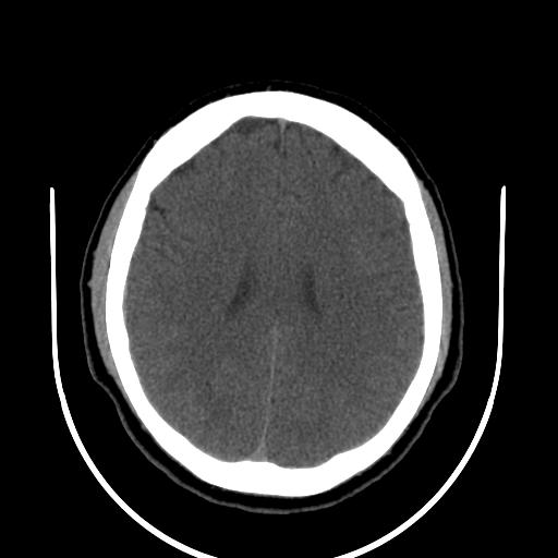 File:Cerebellar infarction (Radiopaedia 16625-16327 Axial non-contrast 25).jpg