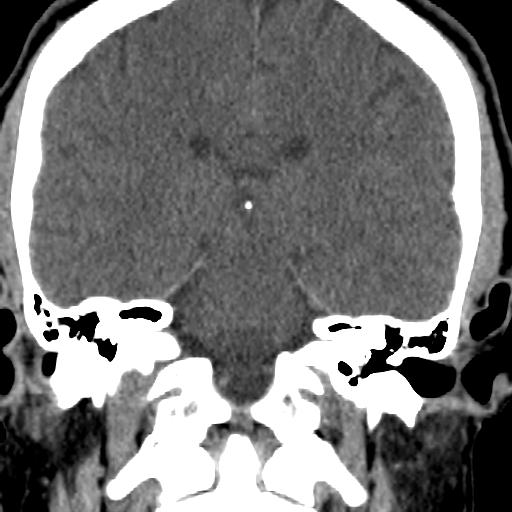 Cerebellar infarction (Radiopaedia 16625-16327 Coronal non-contrast 15).jpg