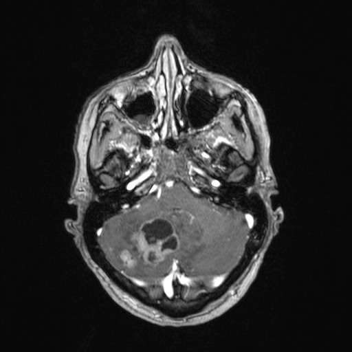Cerebellar metastases (Radiopaedia 24038-24249 Axial T1 C+ 41).jpg
