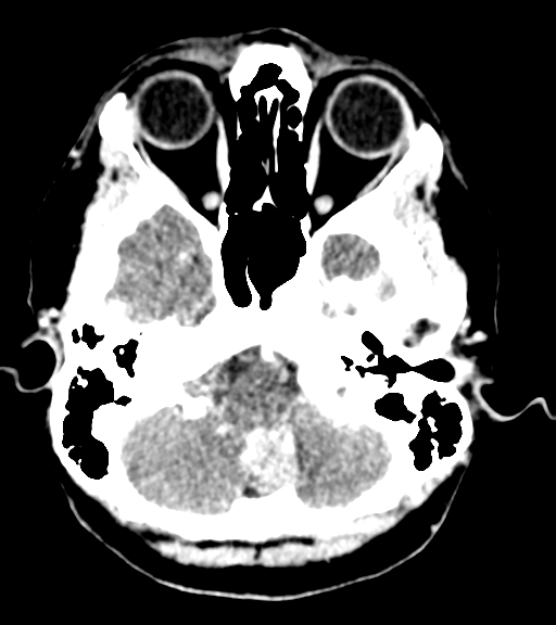 Cerebellar metastases - colorectal adenocarcinoma (Radiopaedia 40947-43652 Axial C+ 8).png