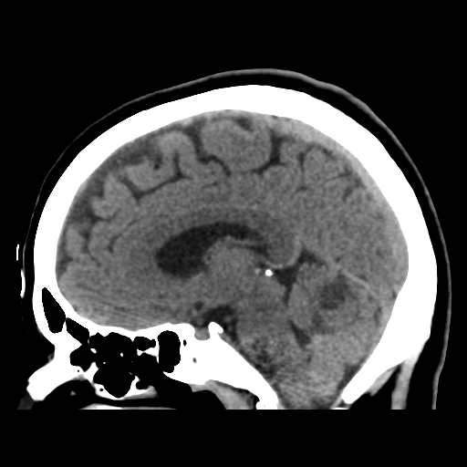 Cerebellar metastasis (cystic appearance) (Radiopaedia 41395-44258 E 28).png
